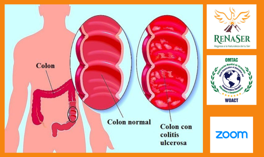 Descubre la Verdad Oculta de la Colitis Ulcerativa: Tu Camino Hacia la Sanación y el Bienestar